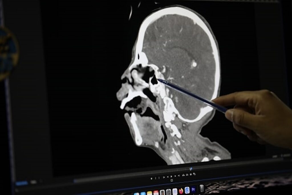 miiase-oral-150-larvas-na-boca-2